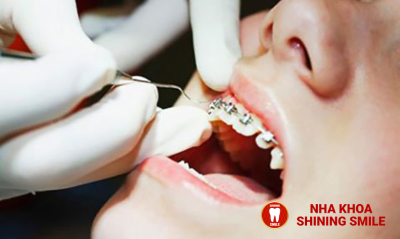 Mắc Cài Inox Tự Đóng: Lựa Chọn Hiệu Quả Cho Niềng Răng