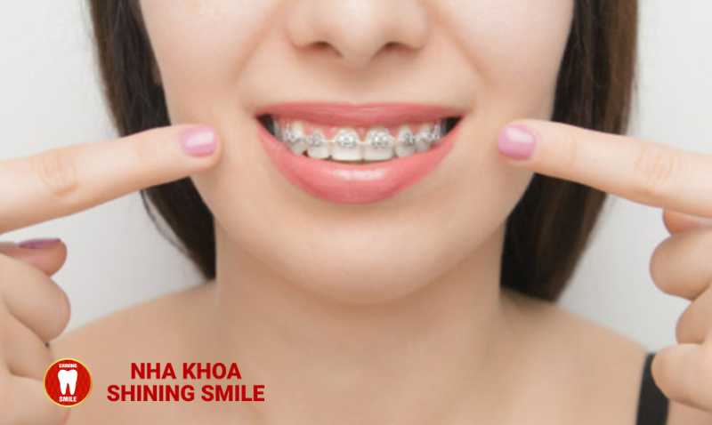 Lệch Nhân Trung Khi Niềng Răng: Nguyên Nhân và Cách Điều Chỉnh