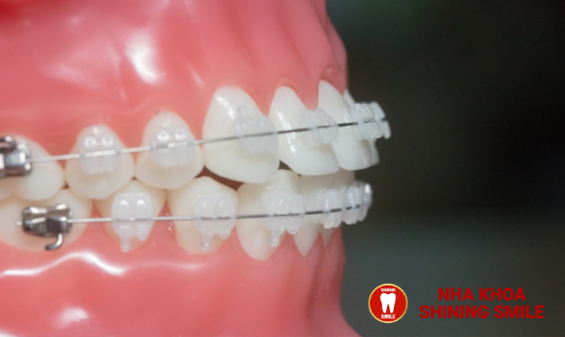 Mắc Cài Tự Buộc 3M: Tính Năng Nổi Bật và Ưu Điểm