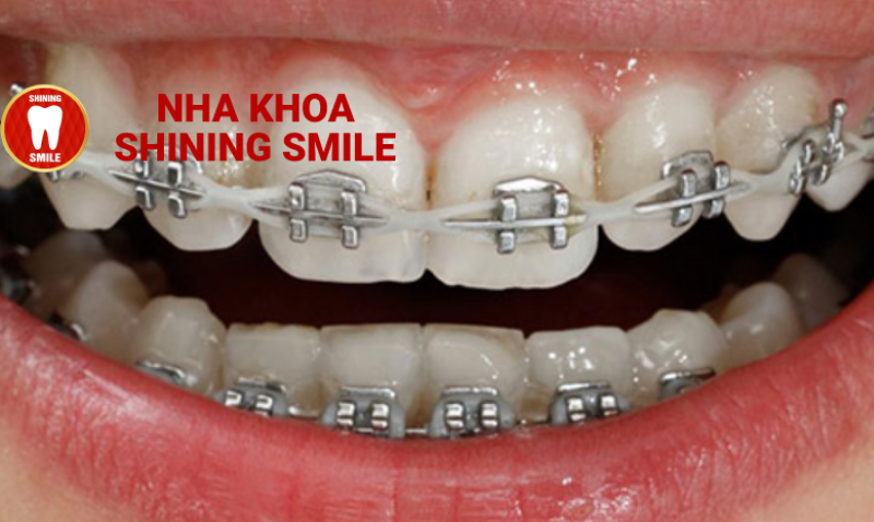 Đặc Điểm Của Mắc Cài Kim Loại 3M Trong Niềng Răng