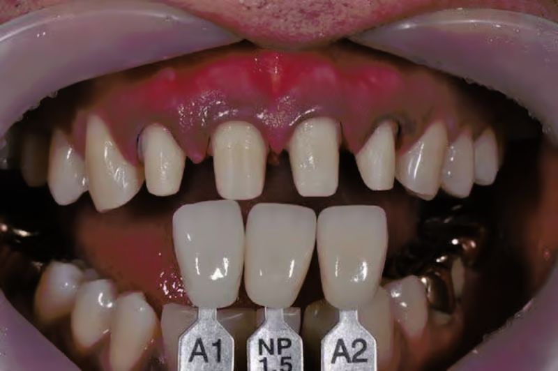 Răng Lấy Tủy Có Nên Bọc Răng Sứ Lại Không? Tư Vấn Từ Chuyên Gia