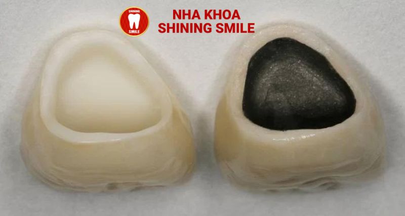 Bọc Răng Sứ Giá Rẻ: Có Nên Chọn Không?