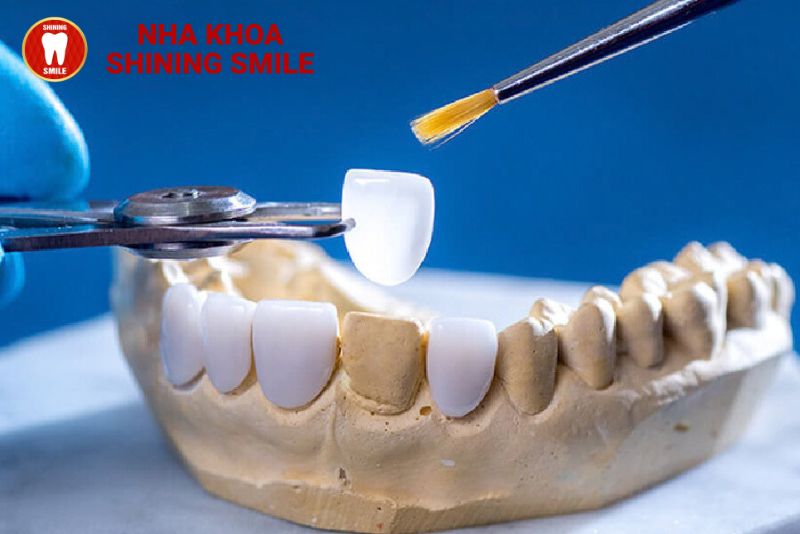 Nhược Điểm Của Dán Răng Sứ? Đánh Giá Chi Tiết