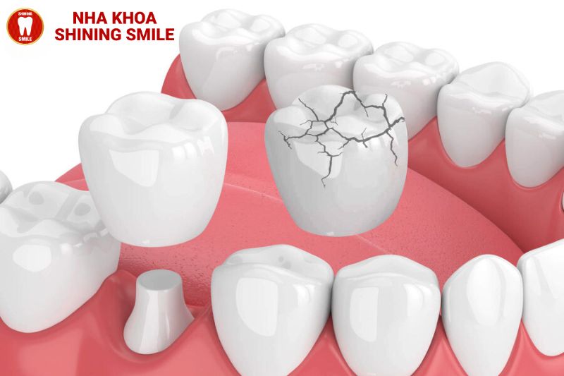 Răng Sứ Bị Mẻ Có Trám Được Không? Giải Pháp Hiệu Quả
