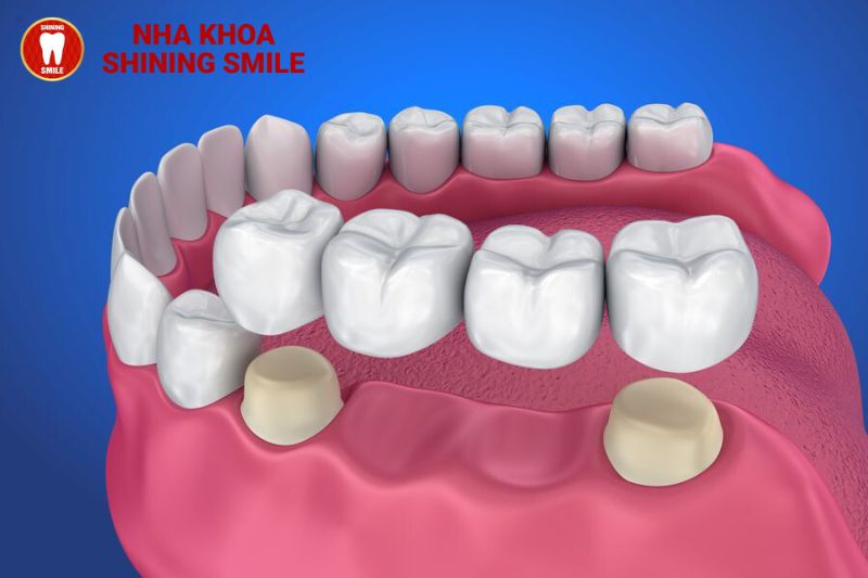 Nhược Điểm Của Việc Bọc Răng Sứ: Những Điều Bạn Cần Biết