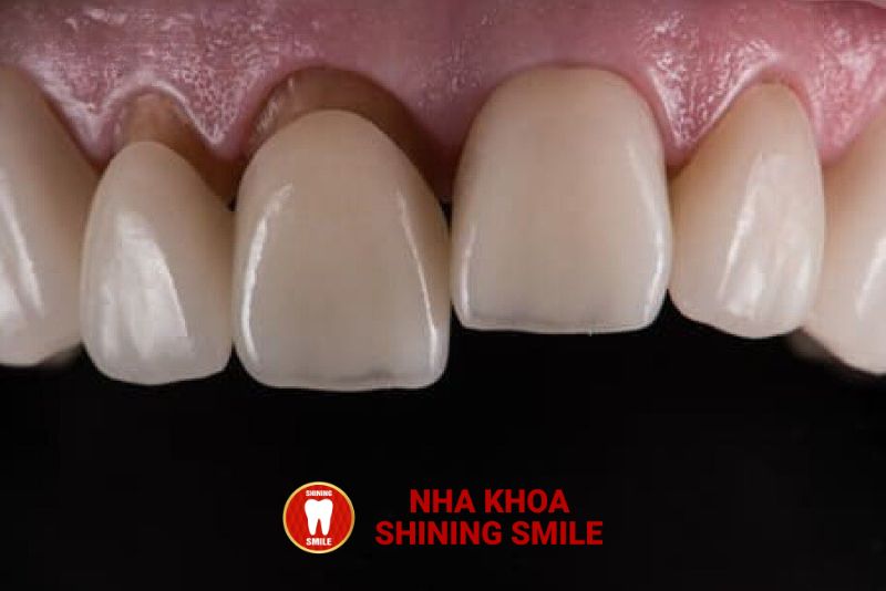 Răng Bọc Sứ Bị Viêm Tủy: Nguyên Nhân Và Cách Điều Trị