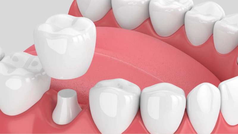 Bọc Răng Sứ 1 Chiếc Được Không? Tư Vấn Từ Nha Khoa