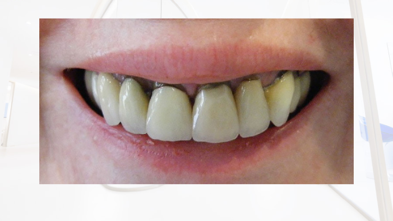 Nguyên Nhân Và Cách Khắc Phục Khi Bọc Răng Sứ Bị Đen Nướu