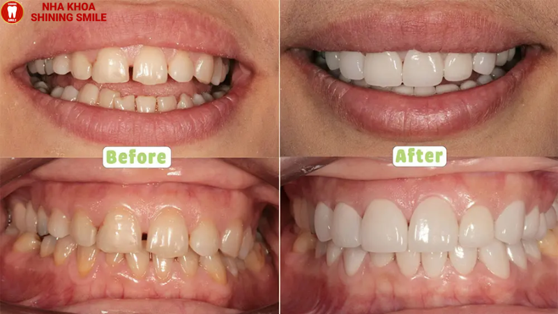 Bọc Răng Sứ Cho 4 Răng Cửa Bị Hô: Giải Pháp Tối Ưu