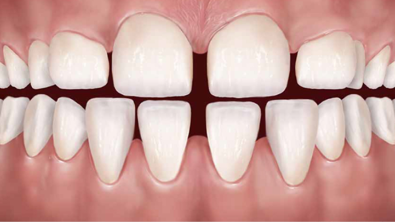 Bọc Răng Sứ Cho Răng Thưa: Lựa Chọn Hoàn Hảo Cho Nụ Cười Đẹp