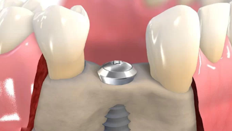 Khi Nào Nên Bọc Răng Sứ? Những Trường Hợp Cần Lưu Ý