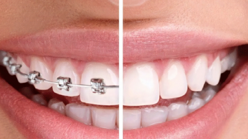 Nên Niềng Răng Hay Bọc Sứ: Lựa Chọn Tối Ưu Cho Nụ Cười