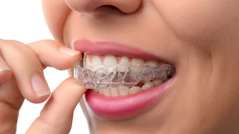 nieng-rang-invisalign-co-hieu-qua-khong1-3.png