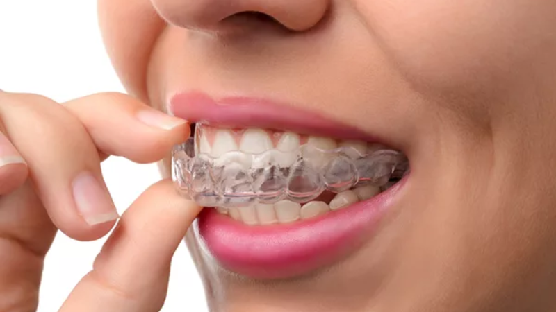 Niềng Răng Invisalign Có Hiệu Quả Không? Trải Nghiệm Thực Tế