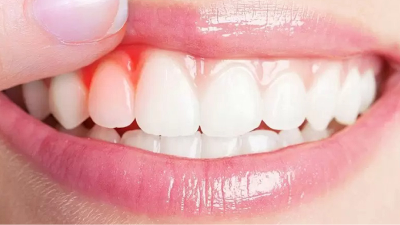 Giải Pháp Khi Răng Bọc Sứ Bị Sưng Nướu