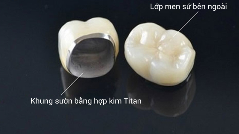 Răng Sứ Titan Có Bị Đen Không? Tìm Hiểu Ngay