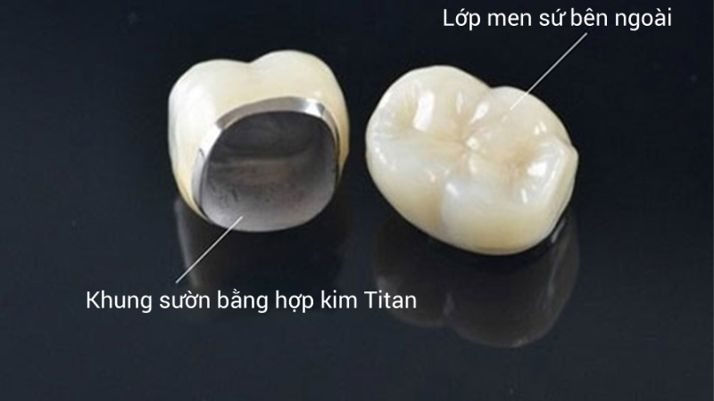 Răng Sứ Titan Có Mấy Loại? So Sánh Và Đánh Giá
