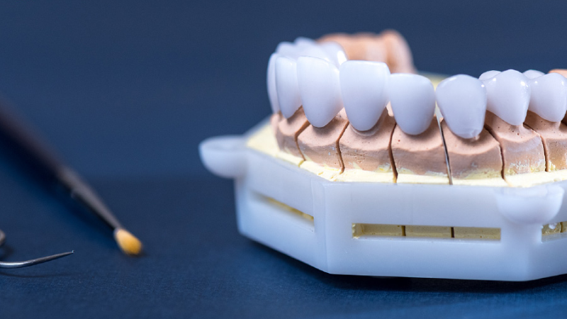 Răng Sứ Vita: Sự Lựa Chọn Hoàn Hảo Cho Răng Thẩm Mỹ