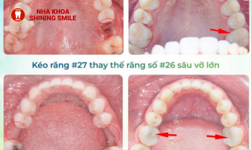 Niềng Kéo Răng 7 và 8: Quy Trình và Đánh Giá