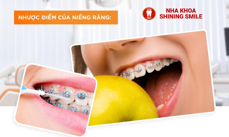 Nhược Điểm Của Niềng Răng: Những Điều Cần Biết Trước Khi Quyết Định