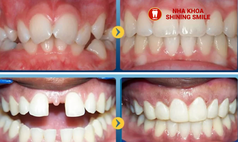 Lớn Tuổi Có Niềng Răng Được Không? Các Yếu Tố Cần Xem Xét