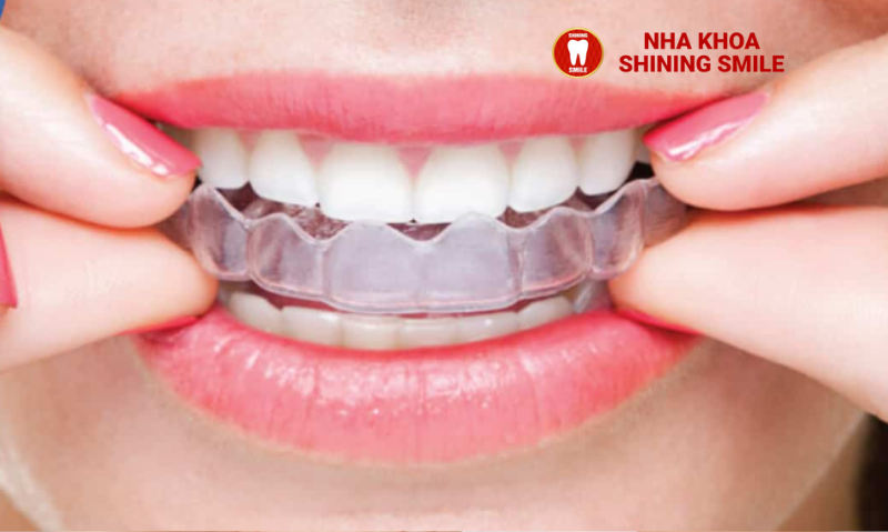 Ưu Điểm Vượt Trội Của Niềng Răng Invisalign: Lựa Chọn Số Một Cho Bạn