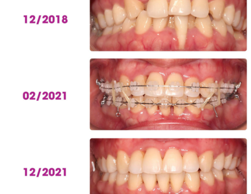 Răng Yếu Có Thể Niềng Được Không? Giải Đáp Từ Chuyên Gia