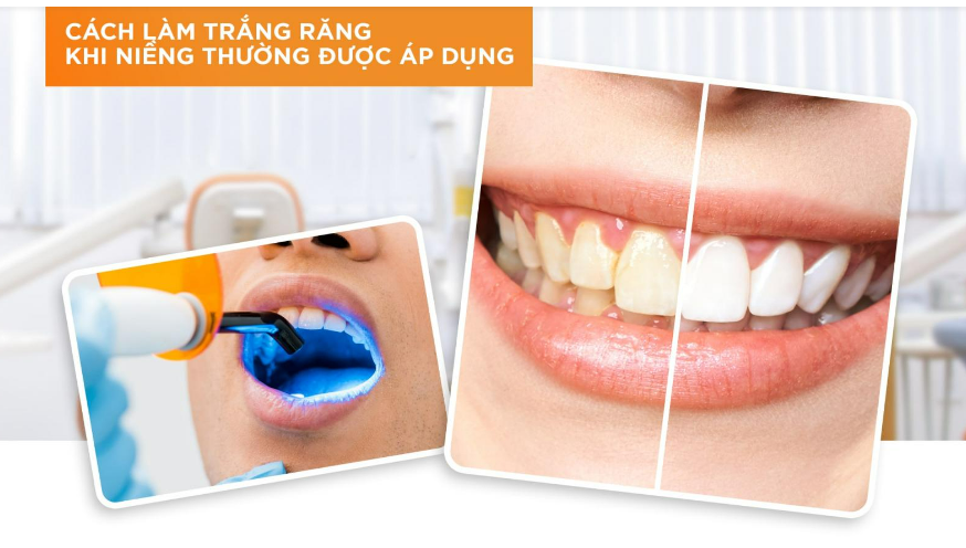 Cách Làm Trắng Răng Khi Niềng: Mẹo Và Phương Pháp An Toàn