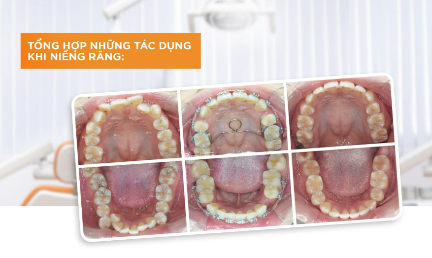 Răng Như Thế Nào Thì Nên Niềng? Tư Vấn Từ Nha Sĩ