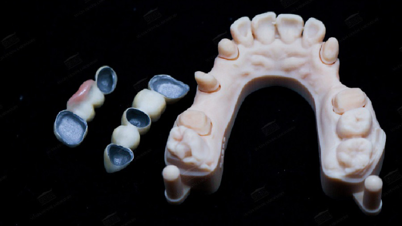 Tác Hại Của Răng Sứ Kim Loại Đến Sức Khỏe Răng Miệng