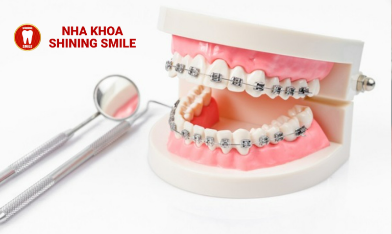 Niềng Răng Ở Tuổi 22: Điều Kiện Và Kết Quả Mong Đợi