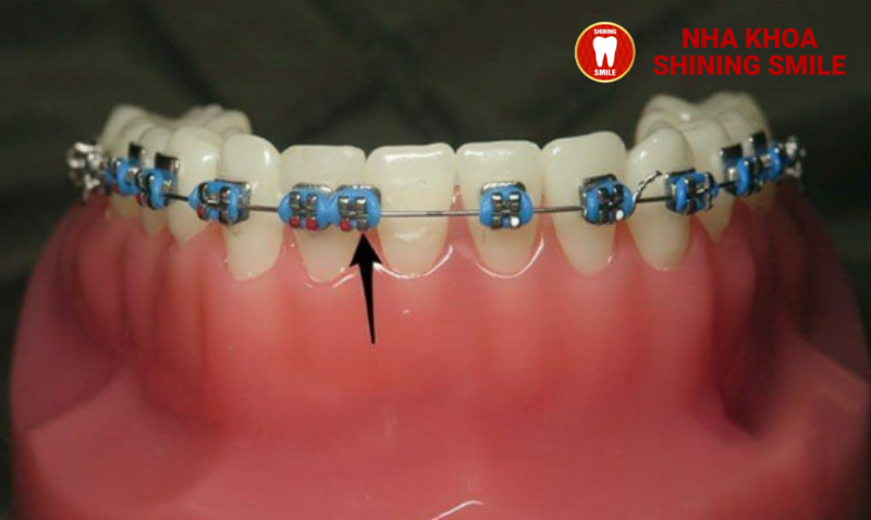 Bung Mắc Cài Khi Niềng Răng: Nguyên Nhân và Cách Khắc Phục