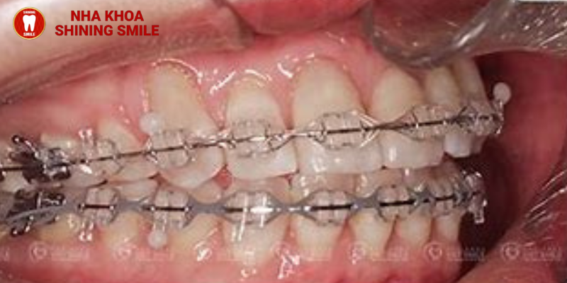 Cách xử lý bị tụt lợi khi niềng răng