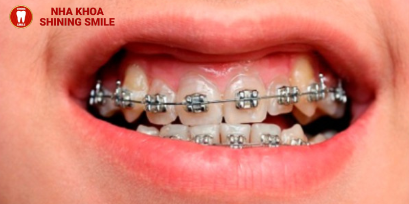 Các Giai Đoạn Niềng Răng: Hành Trình Đến Nụ Cười Hoàn Hảo