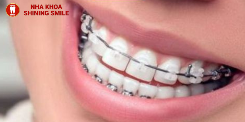 Niềng răng móm bao nhiêu tiền: Mức giá mới nhất 2024