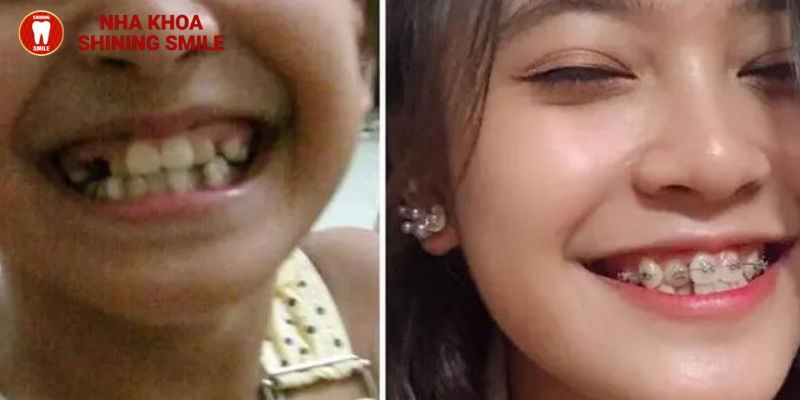 Kết quả niềng răng sau 1 tháng: Sự thay đổi ngoạn mục