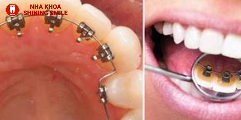 Niềng răng mặt trong: Tất tần tật chi phí từ A-Z