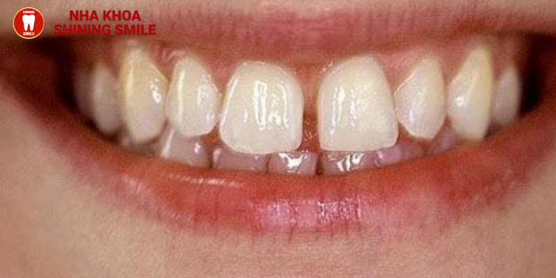 Những điều bạn cần biết về cách khắc phục răng thưa