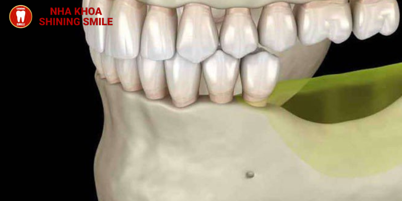 Mất răng có niềng răng được không?