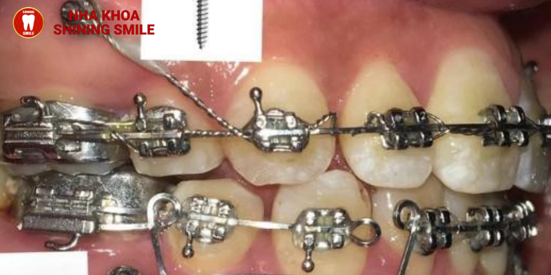 Những điều bạn cần biết về cắm vis niềng răng