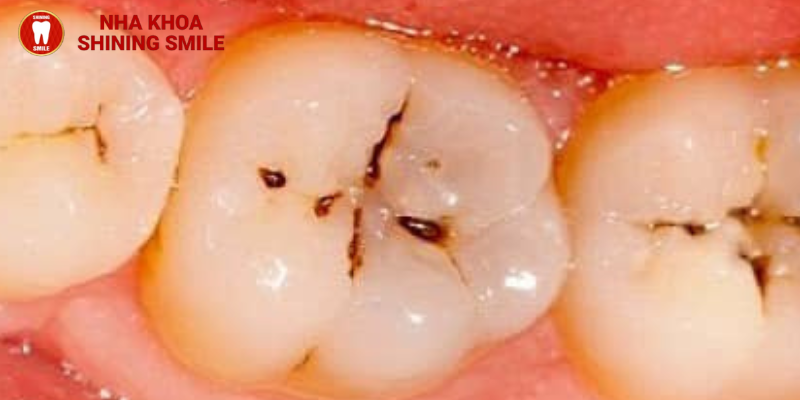 Răng sâu có niềng được không?