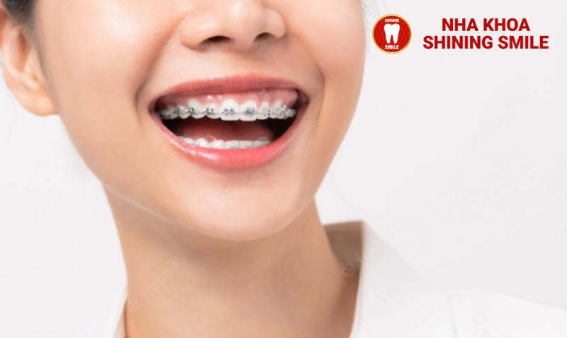 Có Nên Quan Hệ Tình Dục Khi Đang Niềng Răng Không?