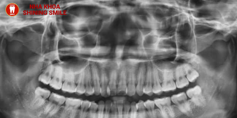 Quy trình niềng răng thường diễn ra như thế nào?