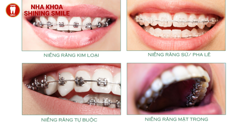 Có nên niềng răng không? Những điều bạn chưa biết về niềng răng