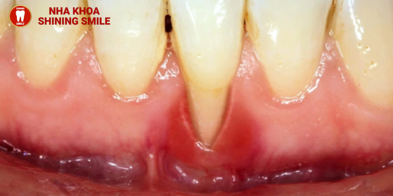 Các tác hại của niềng răng mà hiếm ai nói cho bạn biết