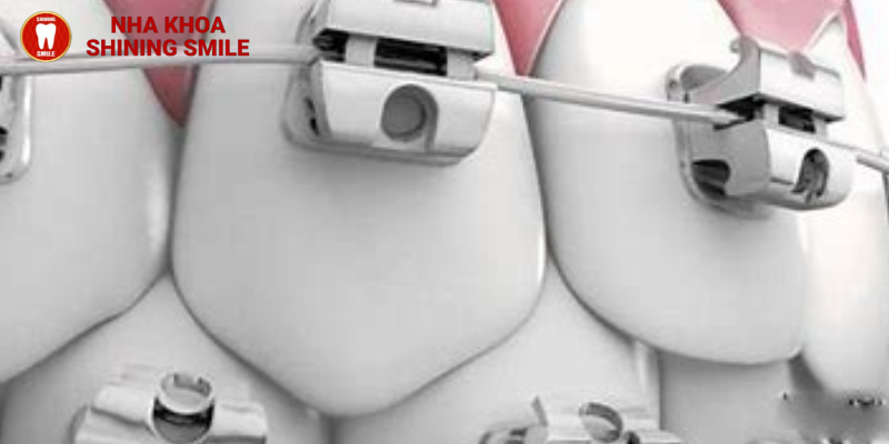 Niềng răng nhanh có hiệu quả không?