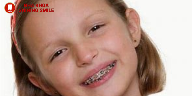 Chi phí trọn gói giá niềng răng cho trẻ 12 tuổi