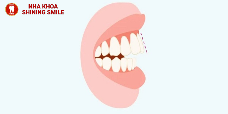 Góc thắc mắc: Hô hàm có niềng răng được không?