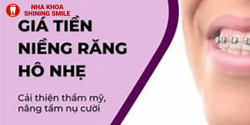 Tất tần tật chi phí niềng răng hô nhẹ