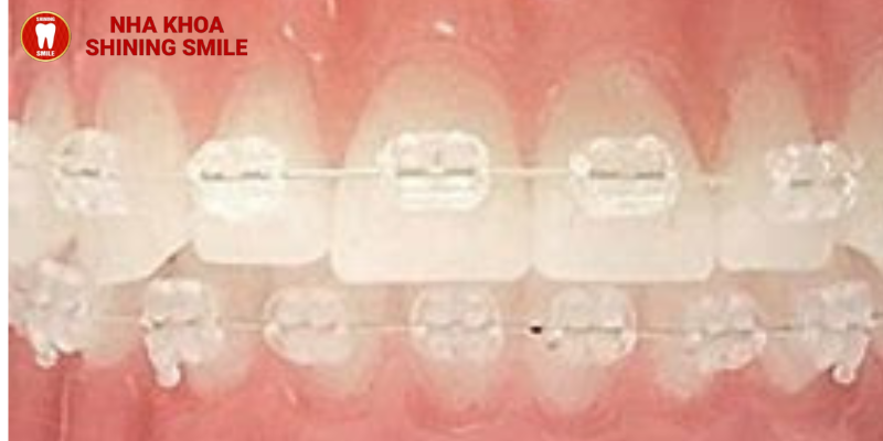 Mắc cài pha lê: Ưu và nhược điểm